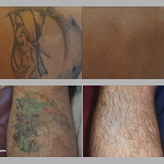Фото до и после удаление татуировок лазером
